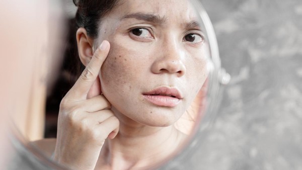 Gambar close-up wajah seorang wanita dengan flek hitam pada pipi, menyoroti detail dan tekstur kulit yang terpengaruh oleh hiperpigmentasi