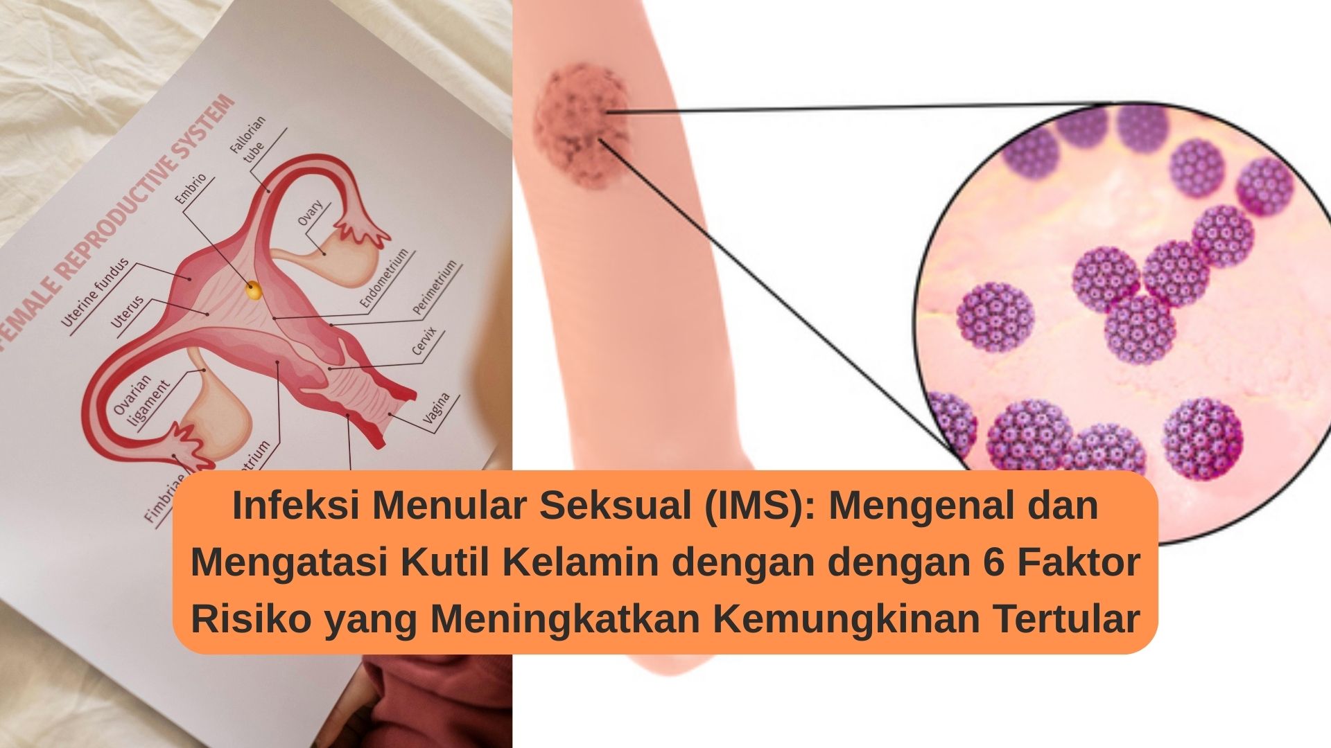 Infeksi Menular Seksual